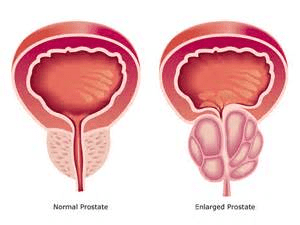 enlarged prostate